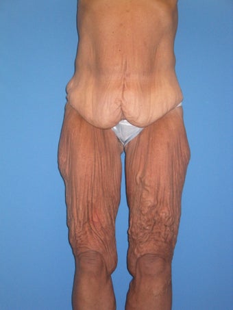 Torsoplasty