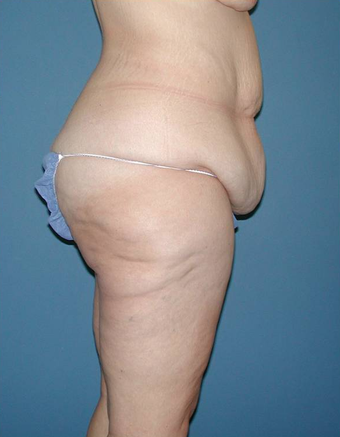 Body Lift