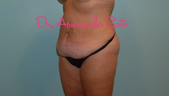 Body Lift after Large Weight Loss