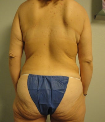 Body Lift 