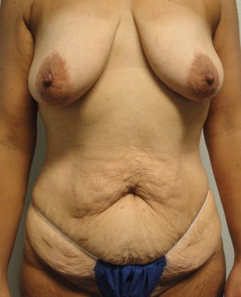 Body Lift 