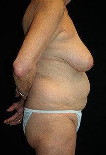 Body Lift