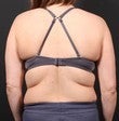 Bra Line Back Lift