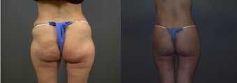 Body Lift