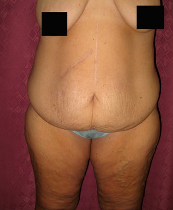 Body Lift after massive weight loss in los Angeles