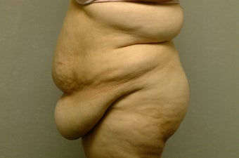 Abdominoplasty-Tummy Tuck with Liposuction