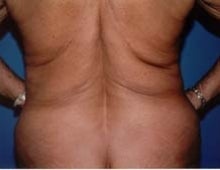 Body Contouring