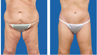 Lower body lift and tummy tuck post gastric bypass surgery - age 57