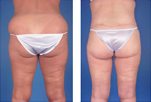 Central body lift with liposuction age 38