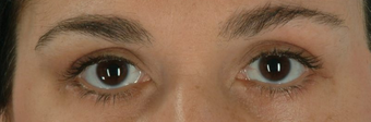 Botox