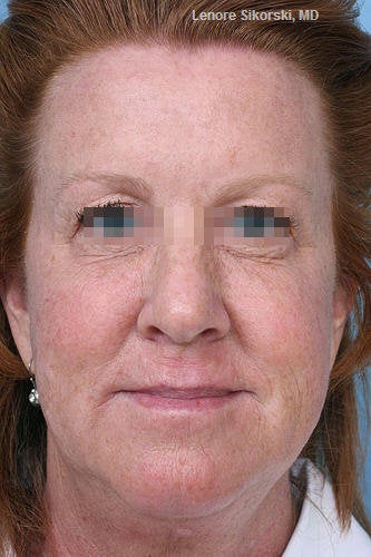 Botox for Forehead, Glabella and Crows Feet