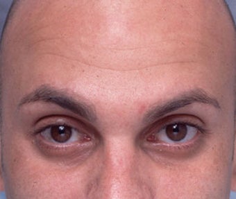 Cosmetic Microdroplet BOTOX® Treatment