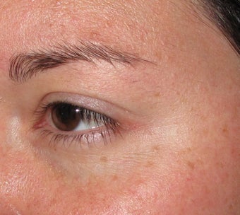 Botox Cosmetic for Crow's Feet wrinkles