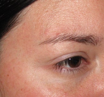 Botox Cosmetic, Crow's Feet