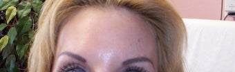 Botox