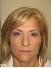 Botox