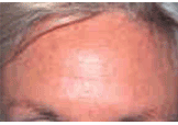 Botox
