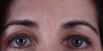 Botox to forehead "11" lines