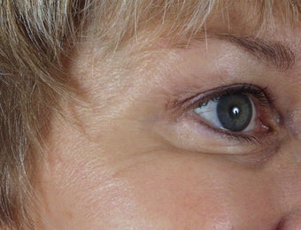 Botox to the crow's feet