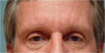 Botox frown lines
