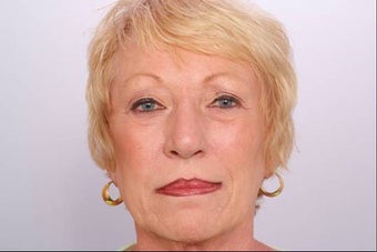 Botox Injection