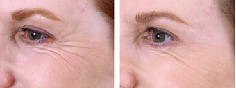 Botox Cosmetic
