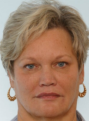 Botox Juvederm Restylane Radiesse