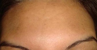botox injections