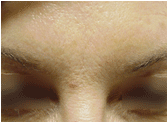 Botox