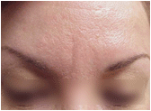 Botox