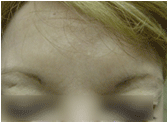 Botox