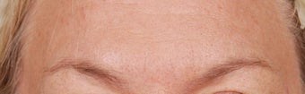 Botox