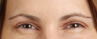 Botox Results