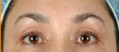 BOTOX 
