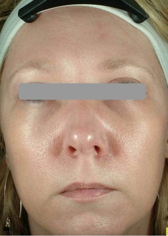 Botox