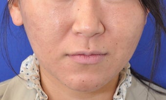 Botox Facial Contouring/Jawline Reduction