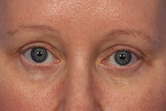 Botox to Crows Feet and Between Eyes (Glabella)
