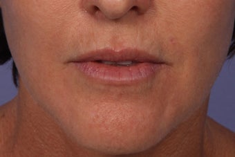 Botox and Juvederm Ultra Plus to Upper Lip