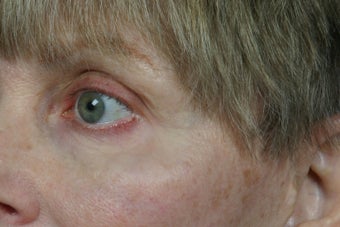 Botox 