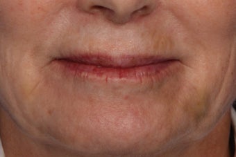 Botox and Juvederm 