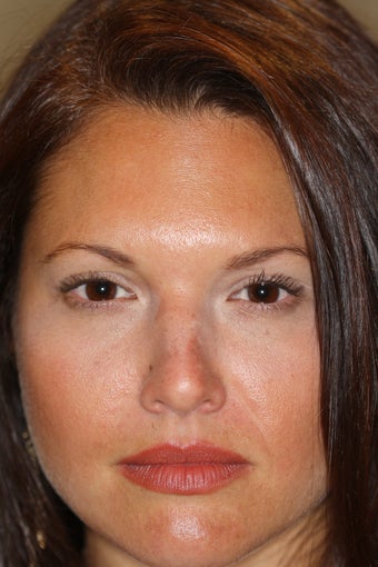 Dysport / Botox