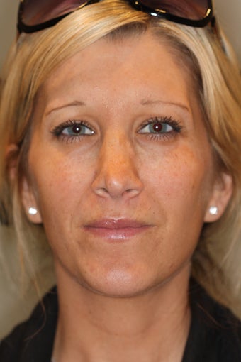 Botox Injection
