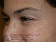 Botox to Periorbital Wrinkles (Crows' Feet)