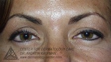 Botox to Glabella (Frown Lines)