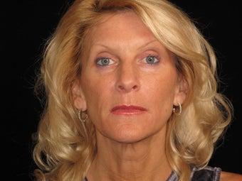 Botox and Restylane