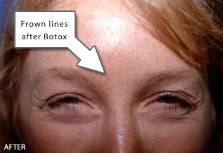 Botox - Glabella