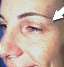 Botox Cosmetic - Crow's Feet