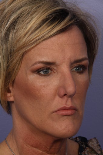Botox 