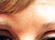 Botox