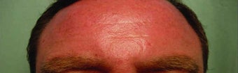BOTOX in the forehead